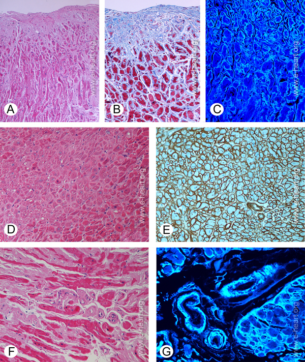 Amyloid histology 1